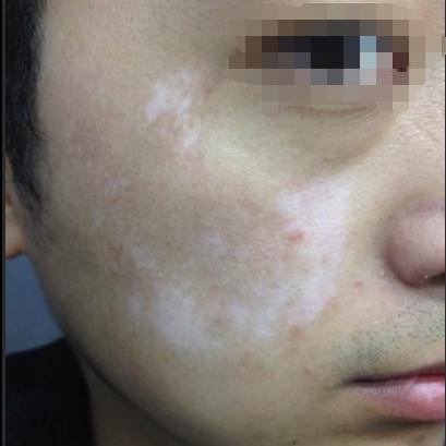 世界白斑最新治疗方法简介